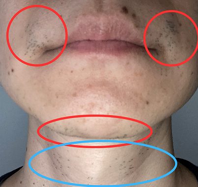 ヒゲ剃り後2日経った顔